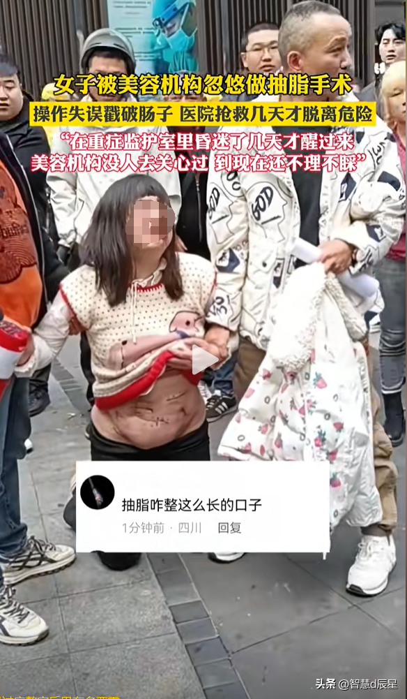 泸州女子被整形机构抽脂戳破肠子,iuc捡回一条命,索赔500万无果