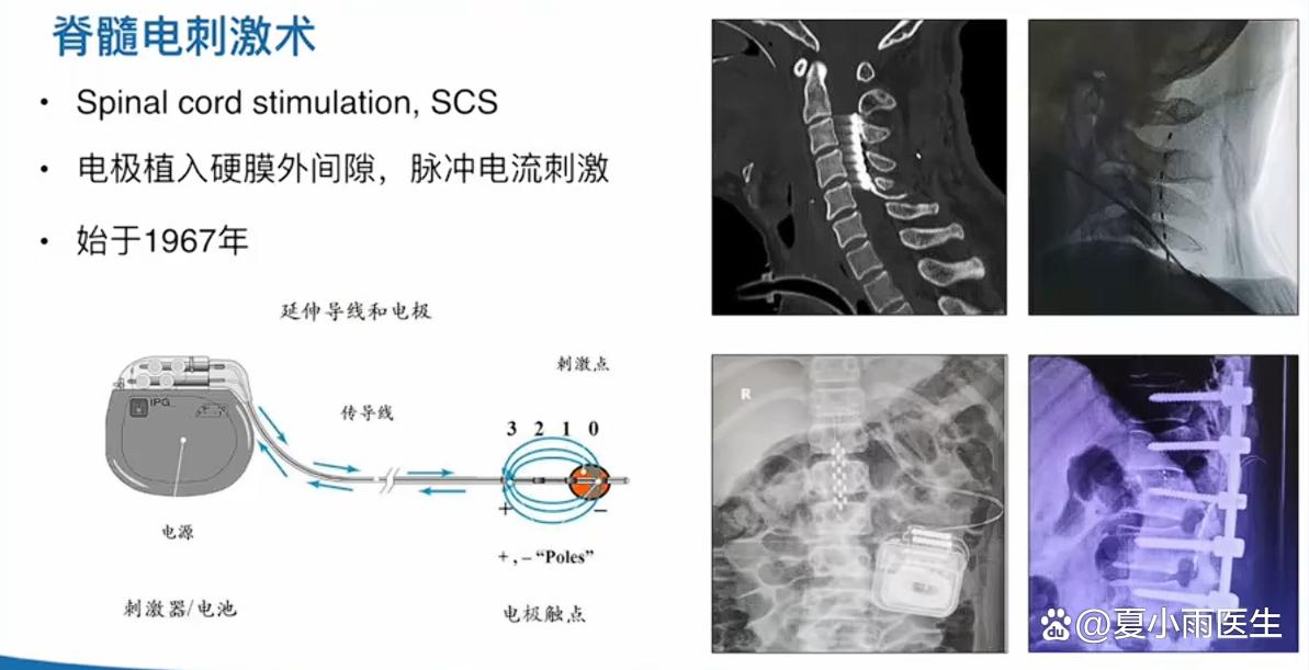 脊髓电刺激术促醒成功率高吗?