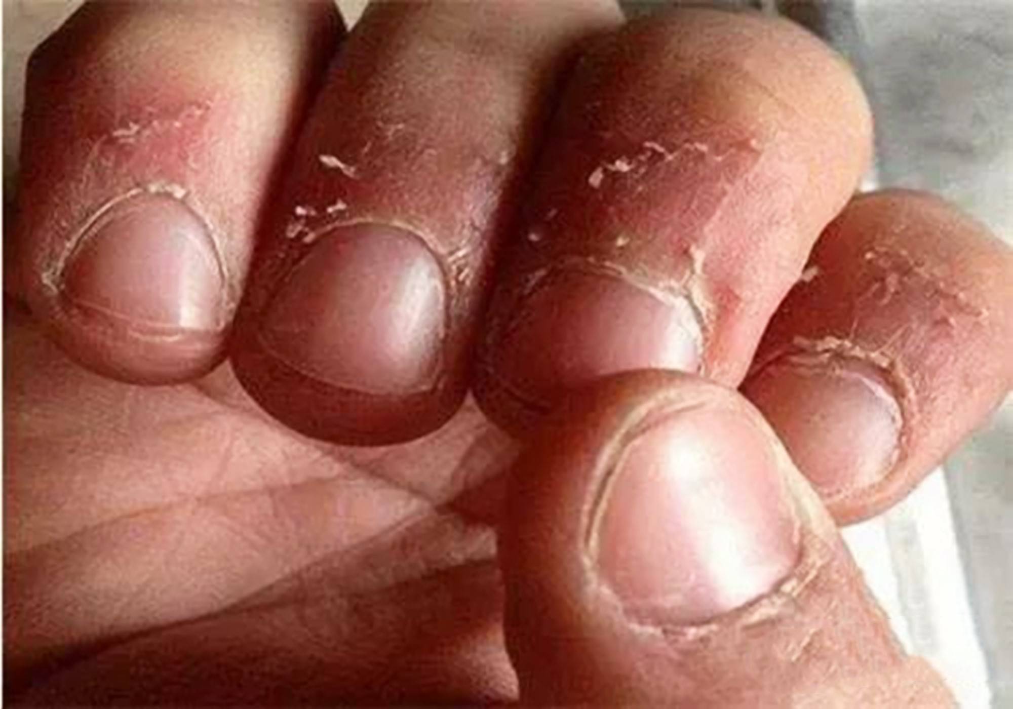 手上长倒刺,严重可导致截肢?爱撕倒刺的注意了!