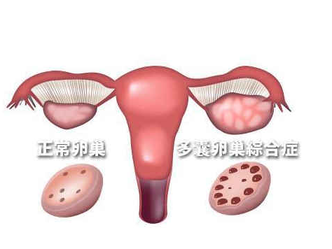 患了卵巢多囊综合征_得了卵巢多囊综合症该怎么办  第2张