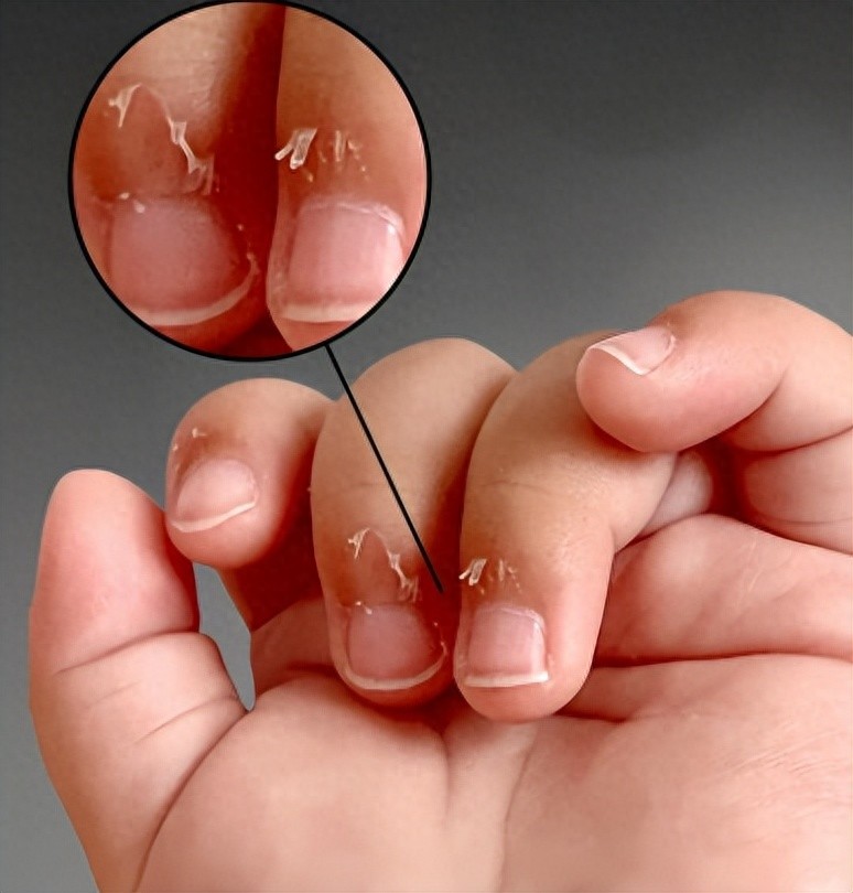 手上长倒刺,不是缺维生素!一次说清倒刺 5 大真相