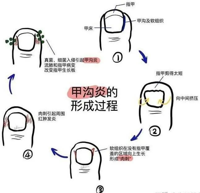 甲床短如何变长图片