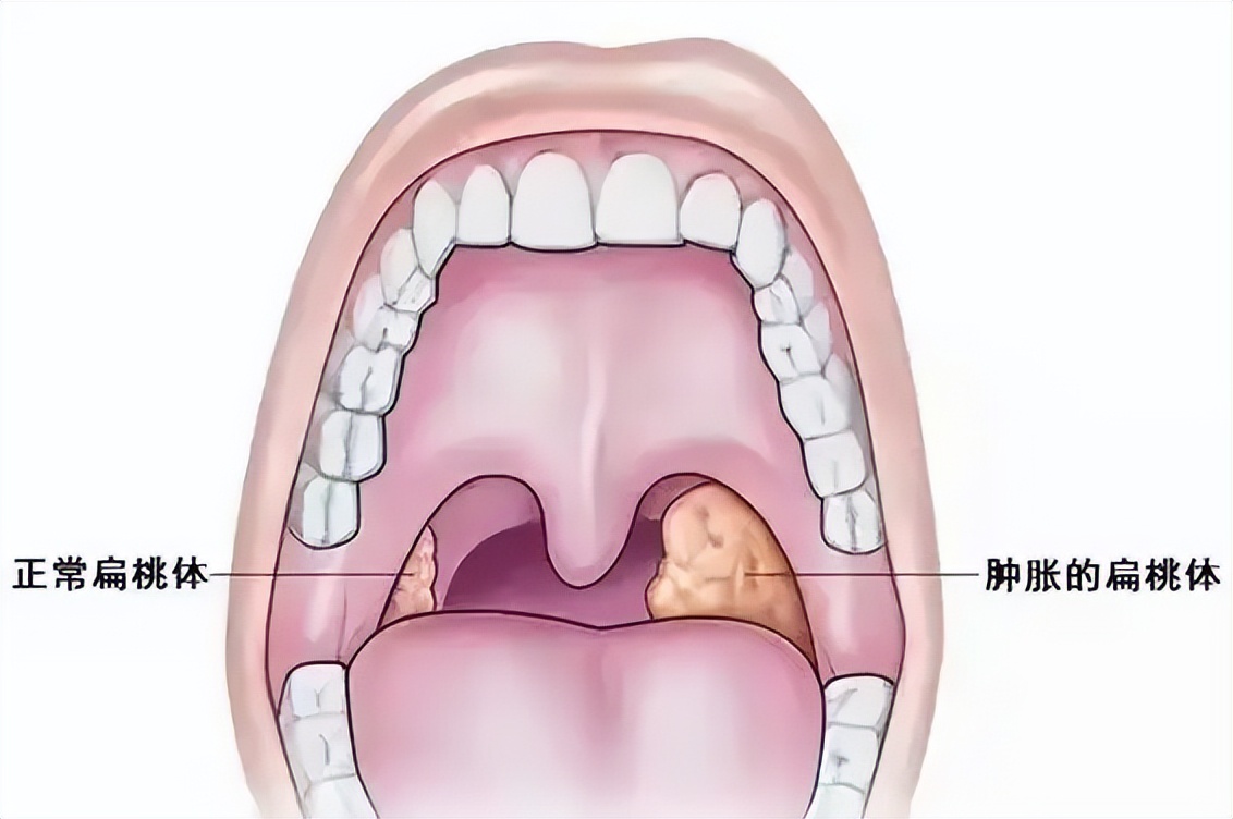 总是刀片嗓,扁桃体要不要切?这几种情况可以切除