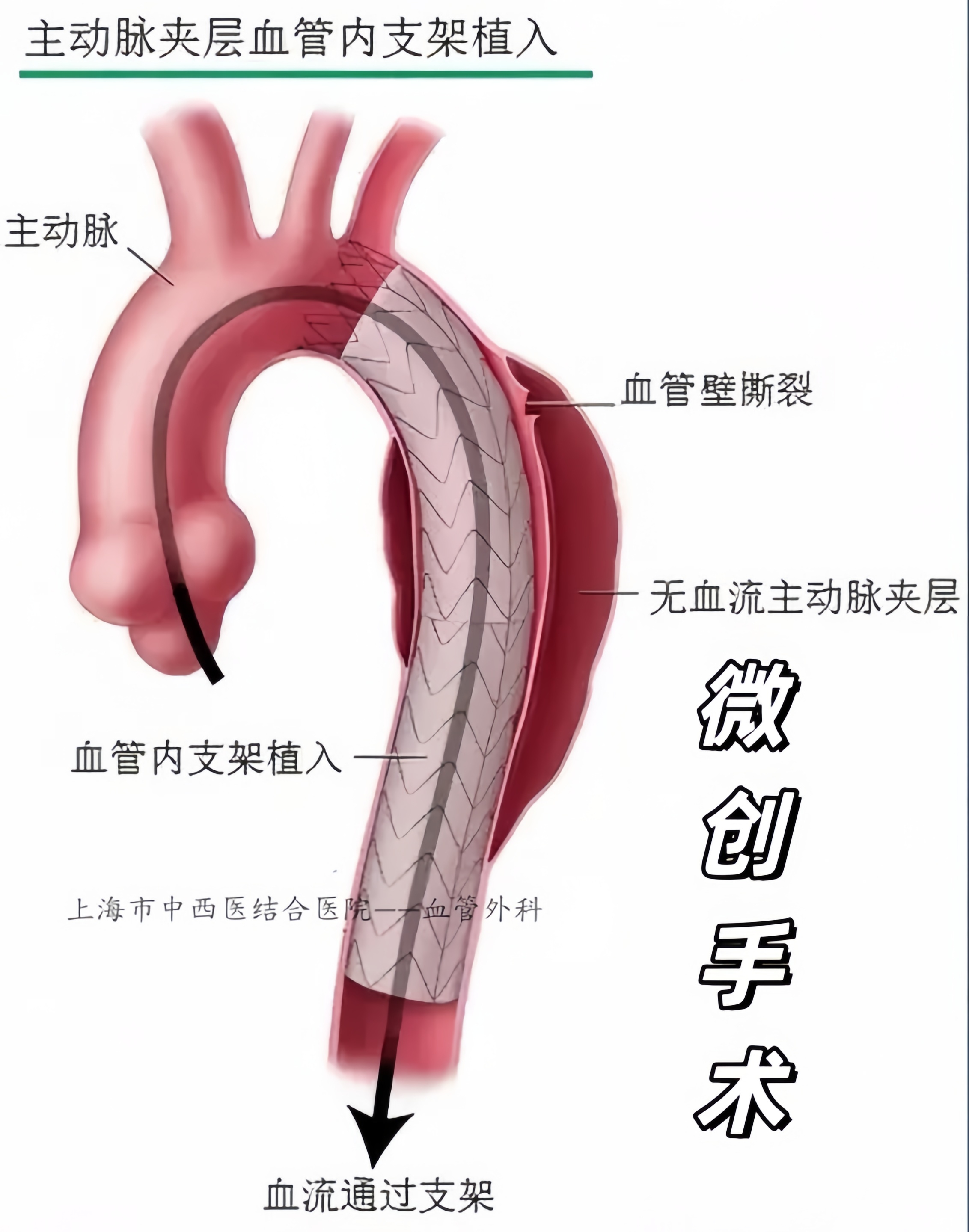 对于累及弓部多根分支的主动脉疾病,如同时累及左锁骨下动脉,左颈总
