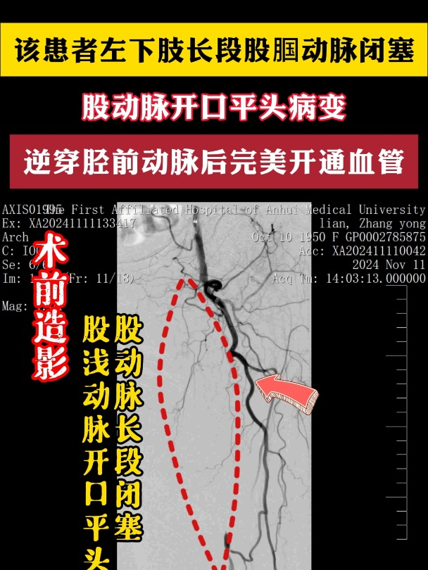 穿动脉图片