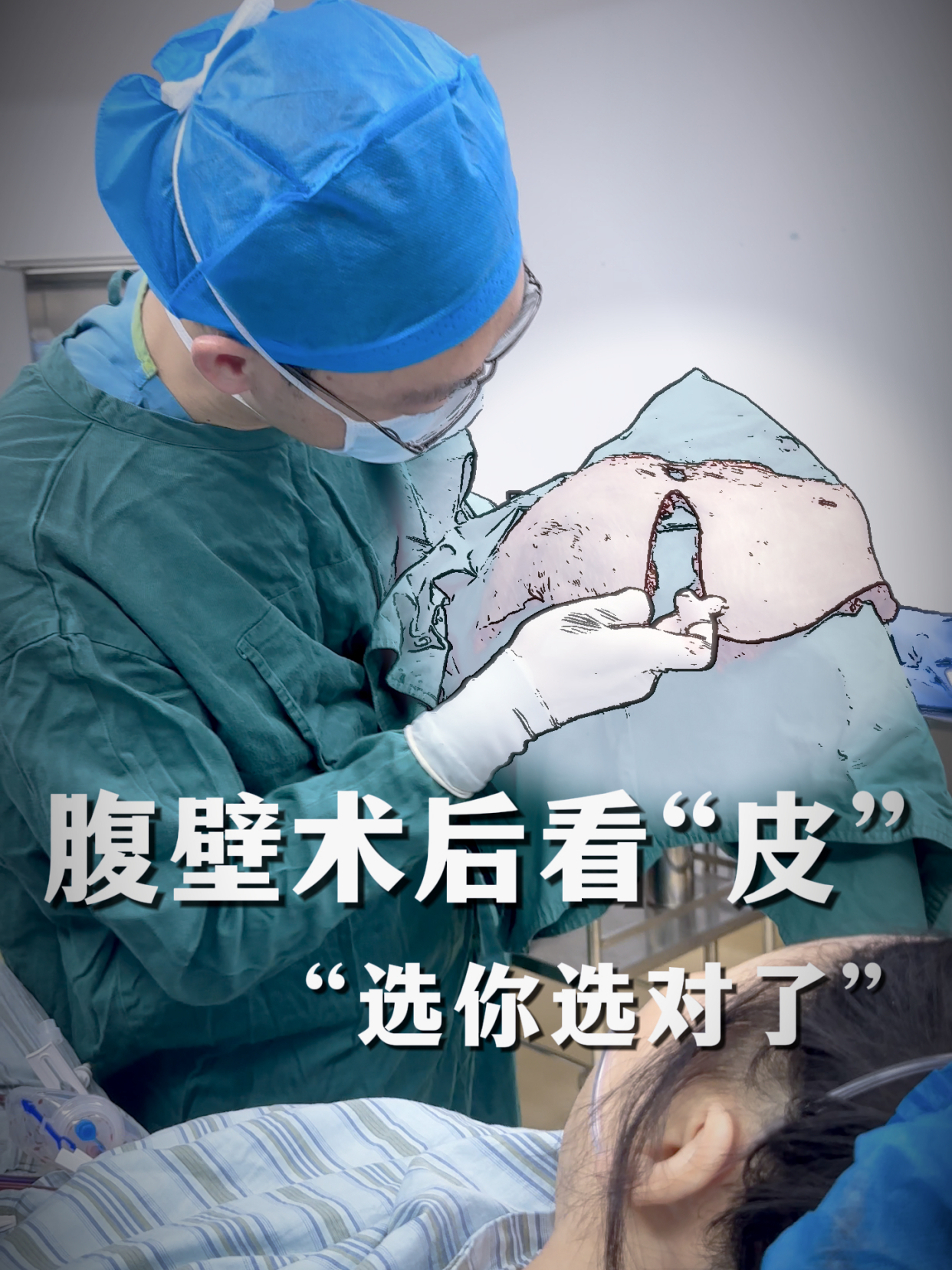 腹壁术后看"皮",求美者:选你选对了