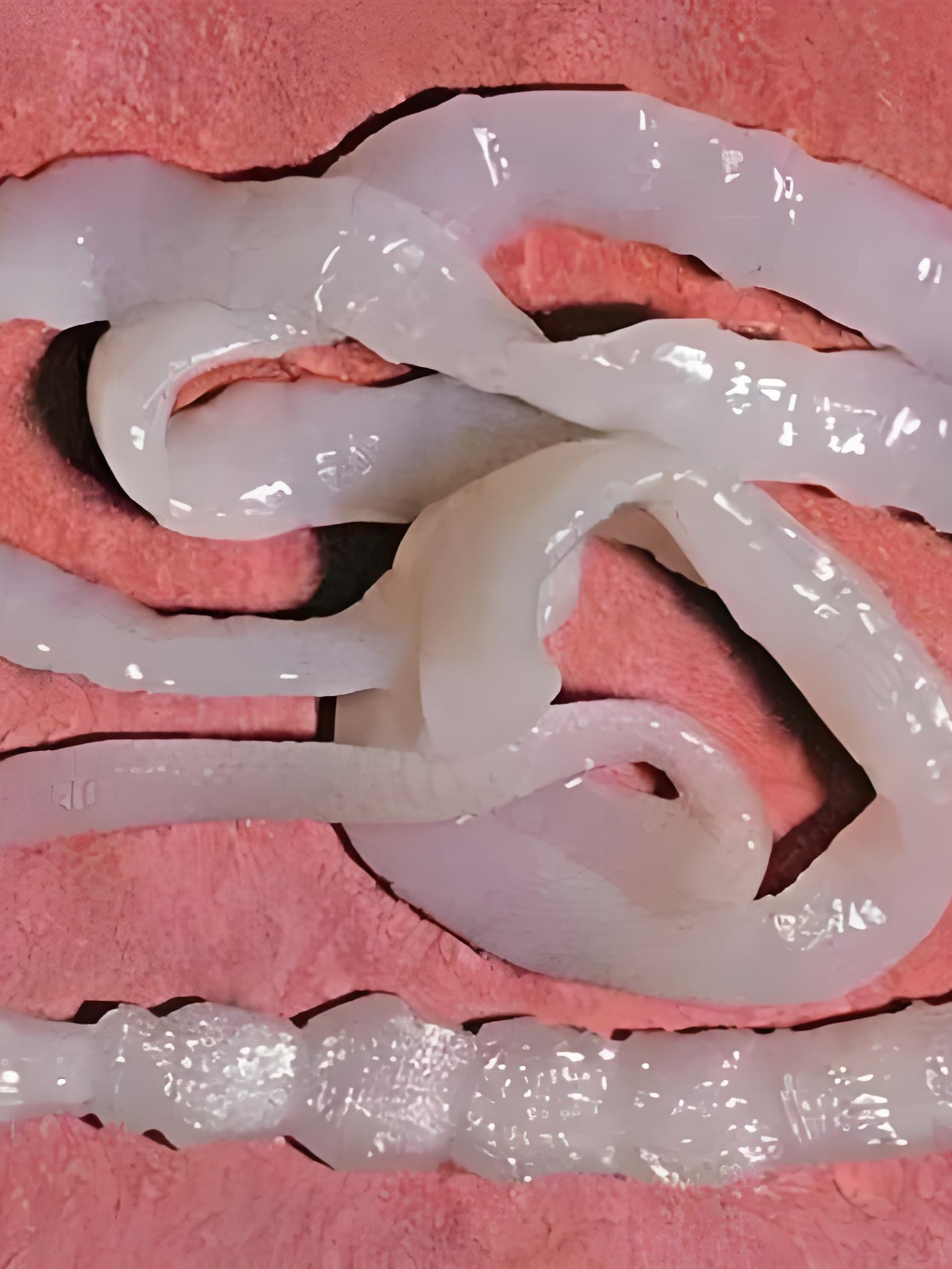 上海女子排出十米寄生虫,疑生食惹祸