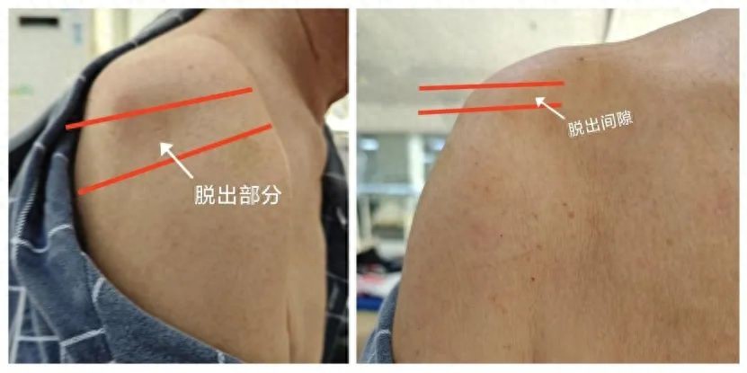 中风后肩膀"掉下来"了怎么办?别怕!康复治疗能帮忙