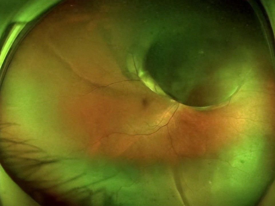 眼底检查"利器"!欧堡超广角成像,带你"尽览眼底"