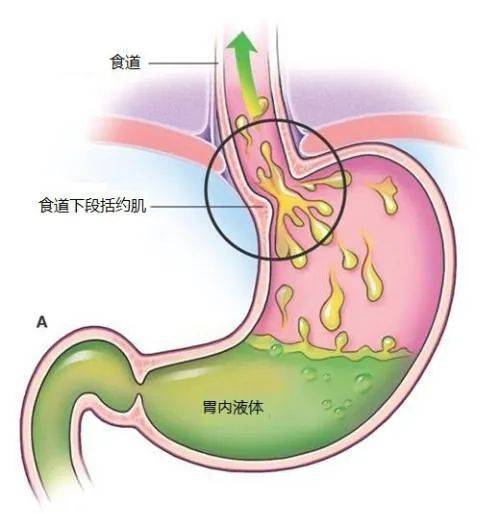 经常打嗝是什么原因造成的?嗳气和呃逆又有什么区别呢?