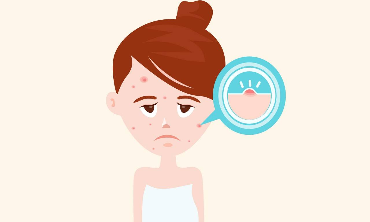 牙膏可以祛痘吗？