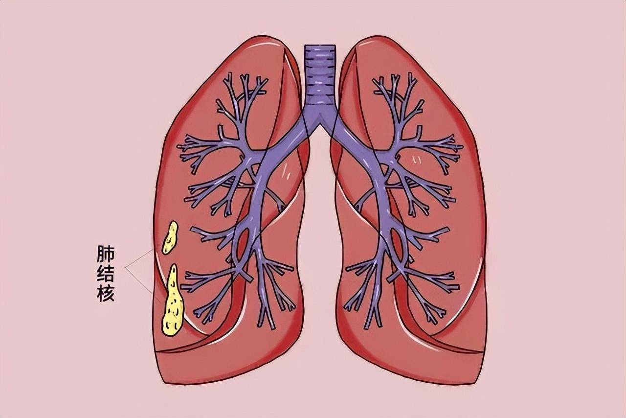 肺结核长什么样图片