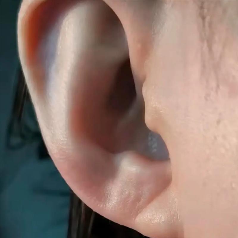 耳朵上有这条折痕,是心梗,猝死的"标志"?来听听医生怎么说