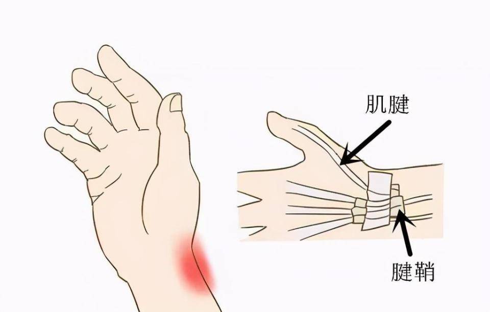 狭窄性腱鞘炎位置图片