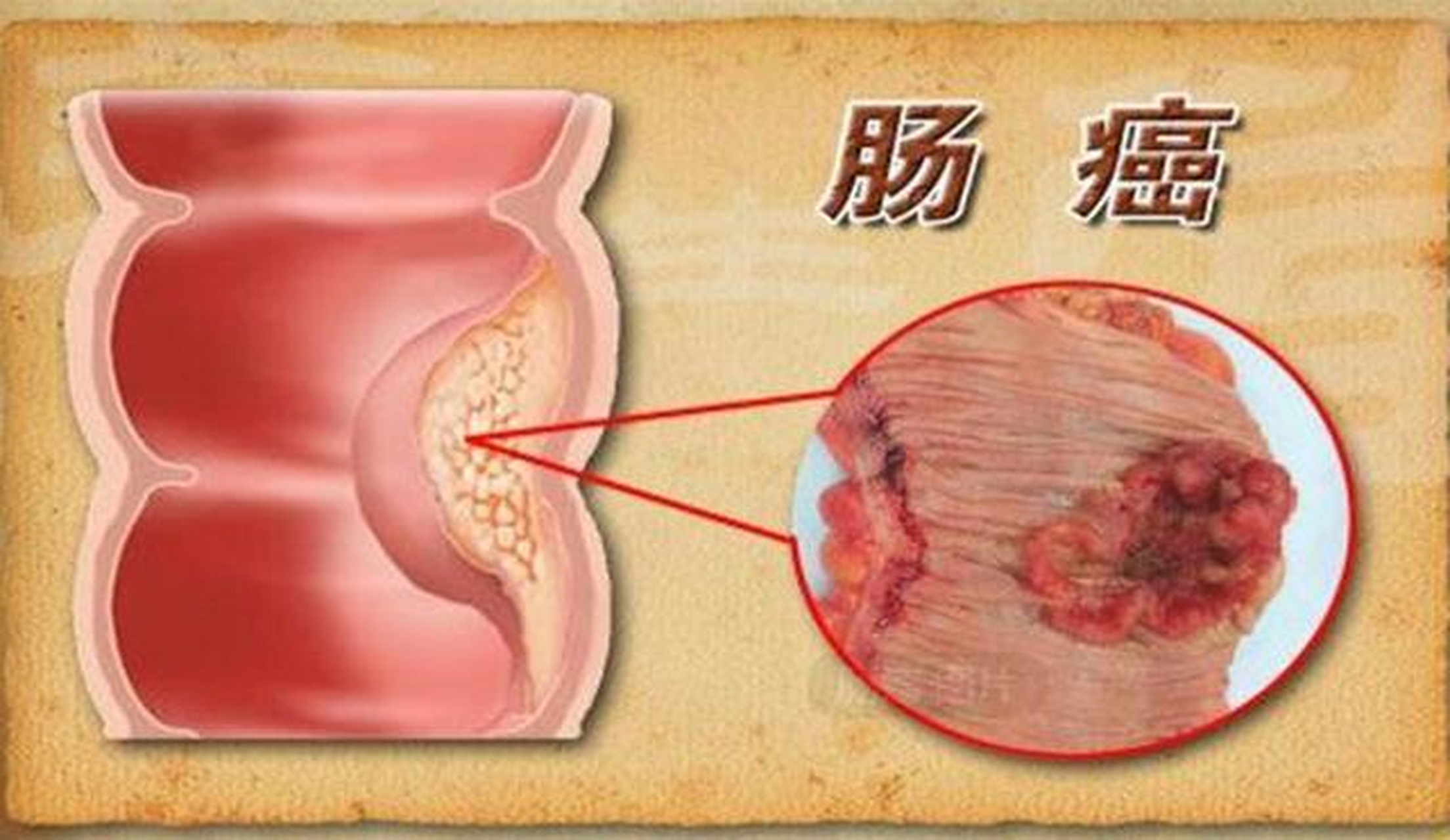 大便异常与肠癌有何关联?留意变化