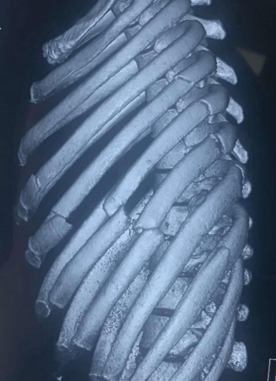 肋骨痛是癌症导致的吗?