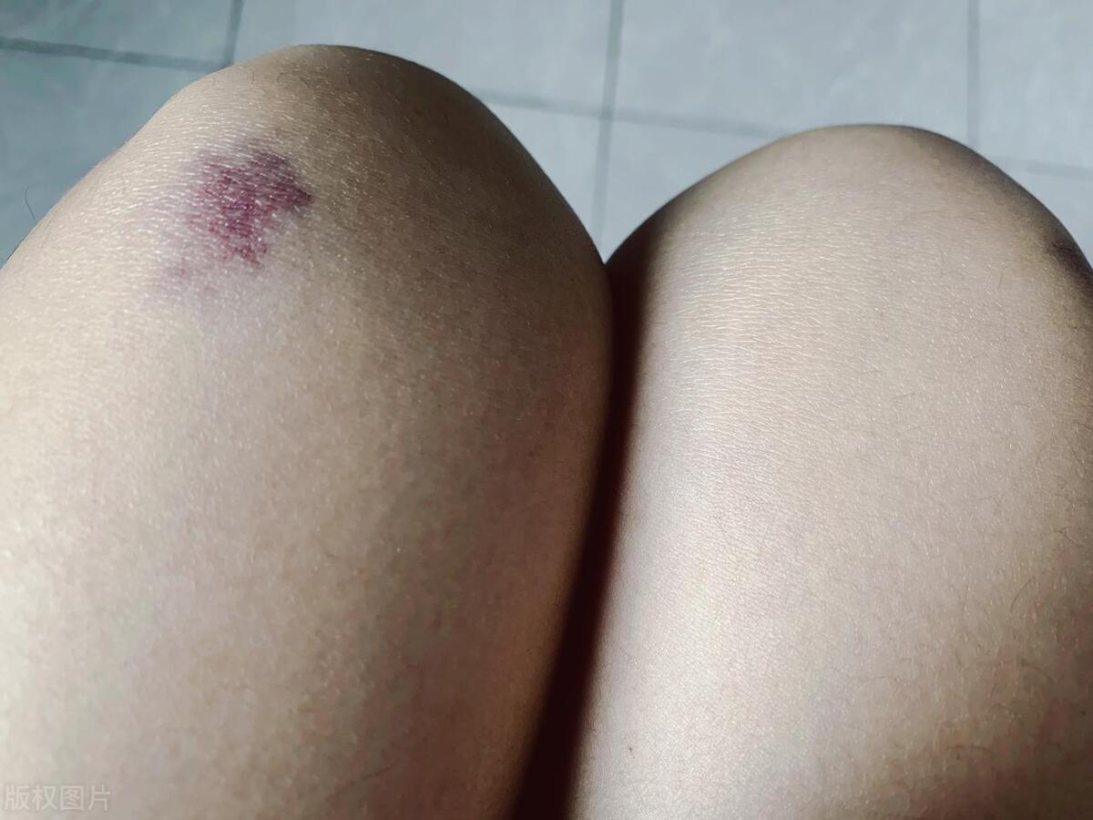 医生提醒:腿上出现这种红血丝,或是疾病信号?