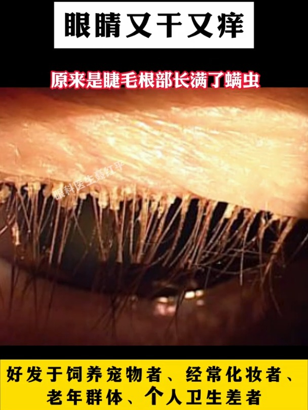 眼睛又干又痒 原来是睫毛根部长满了螨虫!