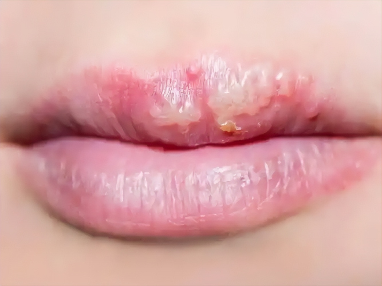 嘴上水泡非上火所致,疼痛难忍,实乃病毒作祟,真相在此揭晓