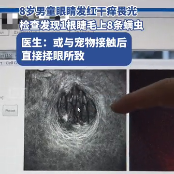8岁男童眼睛发红,干痒,畏光,检查发现1根睫毛上8条螨虫