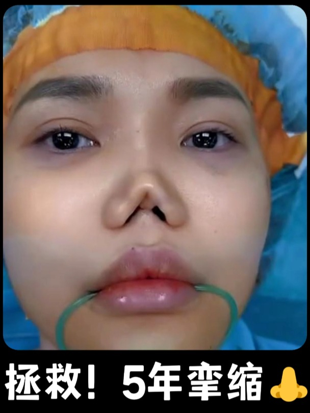 挛缩鼻还能恢复正常吗?5年挛缩鼻,修复后效果绝了!