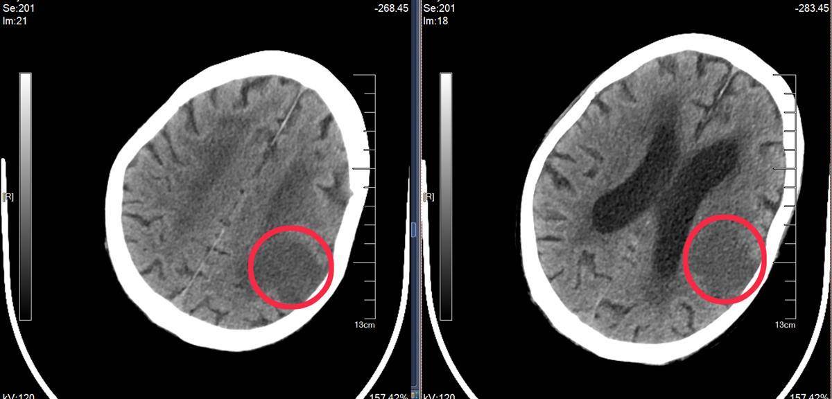 缺血性脑梗死ct图片图片