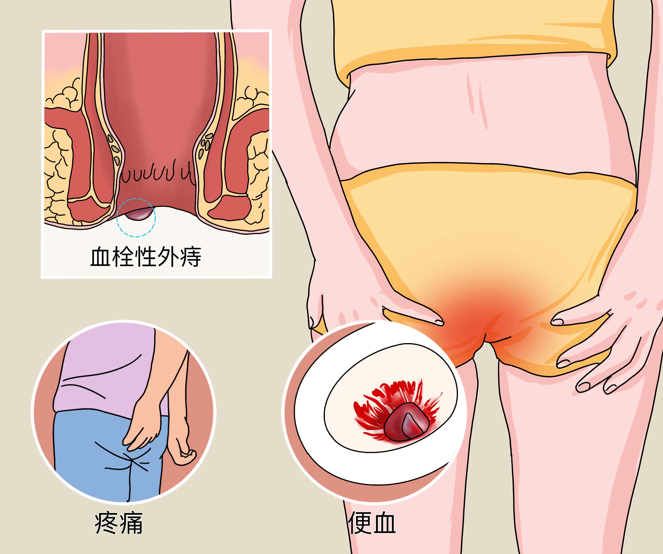 正常肛门 痔疮图片