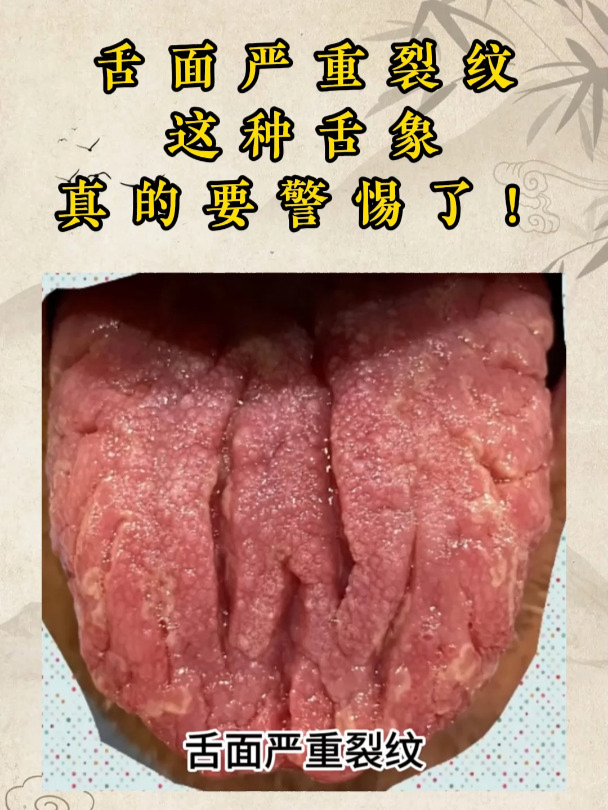 舌面严重裂纹,这种舌象,真的要警惕了!