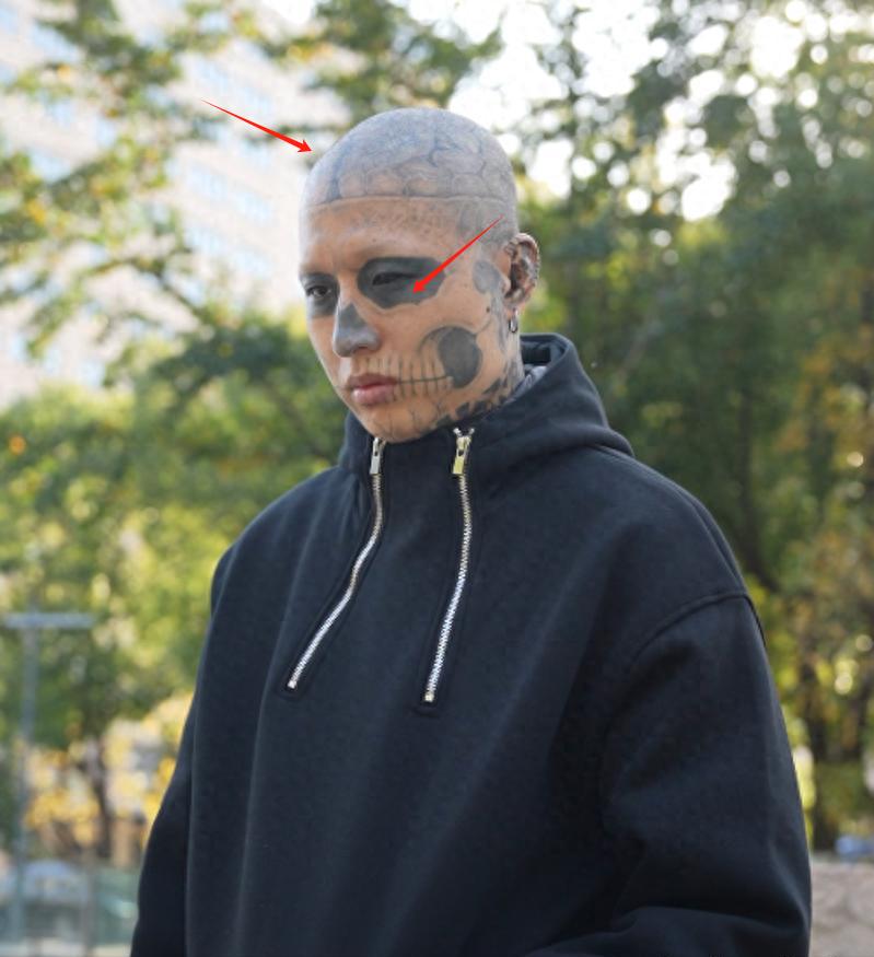 辽宁00后小伙纹面6年后悔,无法人脸识别,工作找不到决定洗纹身