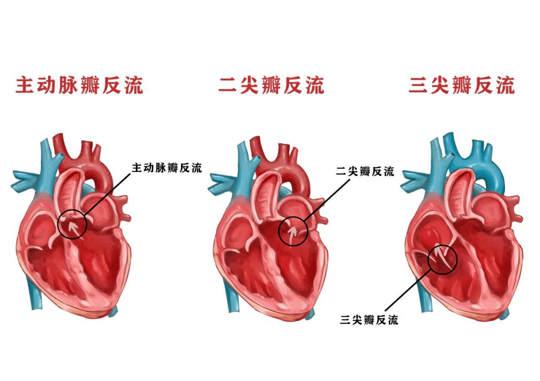 二尖瓣前叶后叶图片