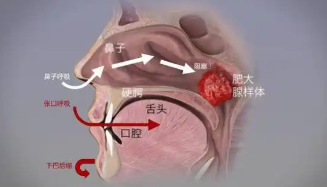 腺样体肥大扁桃体肿大,鼻塞张嘴呼吸打鼾?苍耳子搭配好,好得快