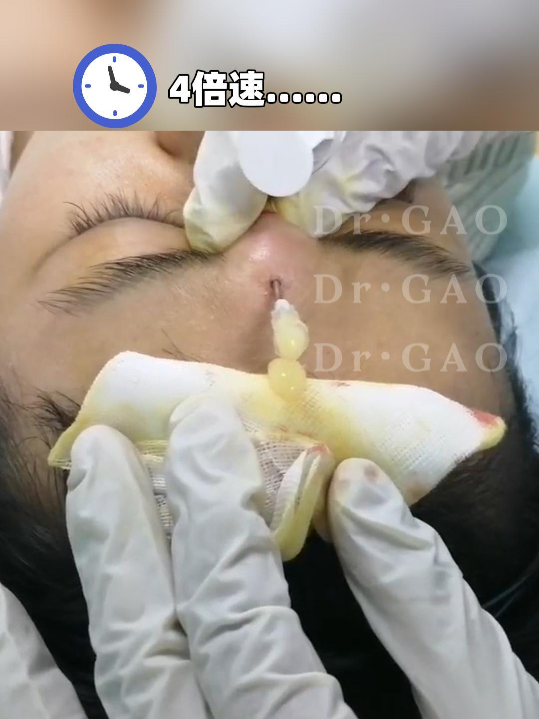 4 倍速下的专业操作:鼻部注射物痛快取出 奥美定 异物