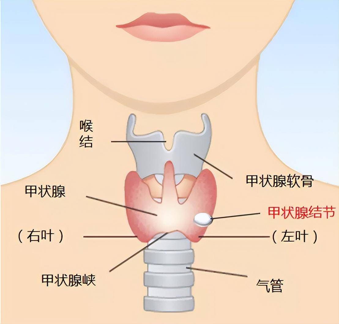 甲状腺结节恶变信号图片