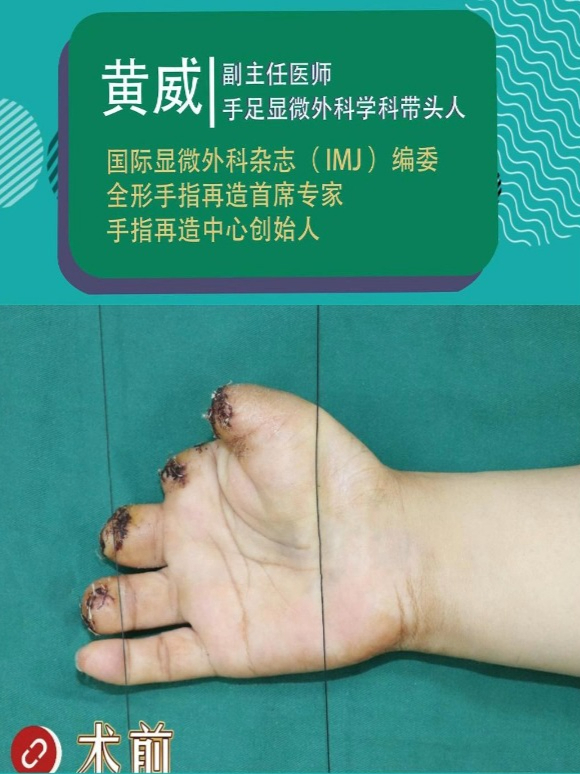 拇指3度缺损的手指再造经历过程