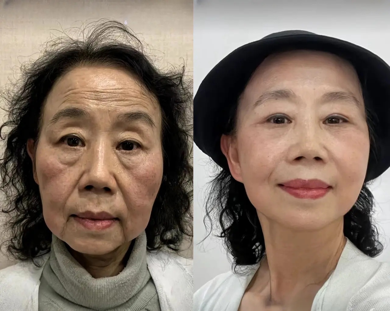 这两个手术不影响,可以同台进行,也可以分开