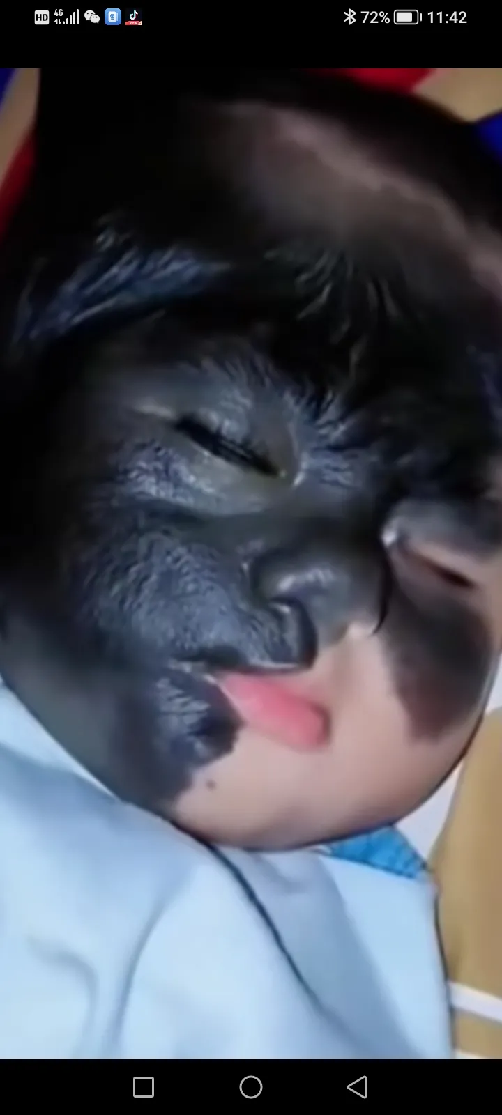 婆婆怒吼着说:当初你们不听话,孕检时医生说:这娃子脸上有黑色物,有