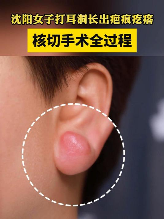 打耳洞形成的疤痕疙瘩,可以这样处理