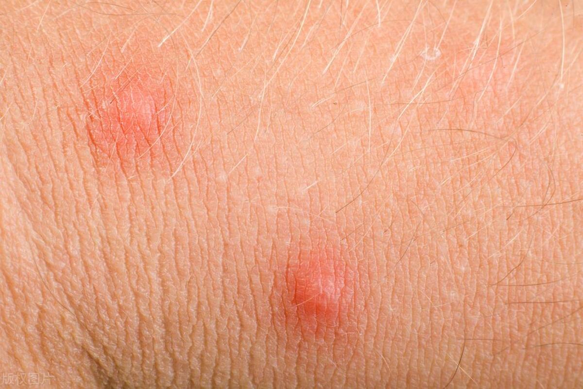 皮肤过敏怎么办?先区分湿疹和荨麻疹