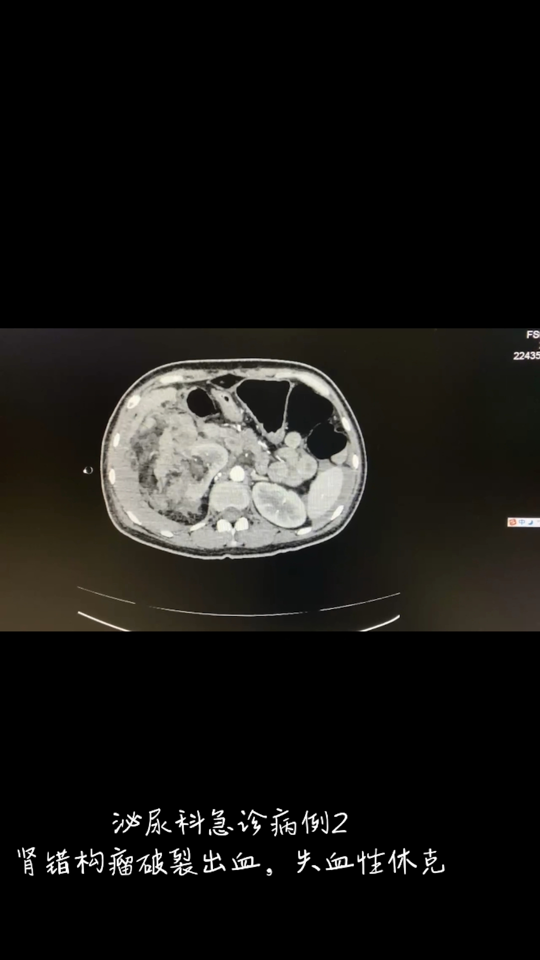 肾错构瘤破裂出血,失血性休克,抢救争分夺秒