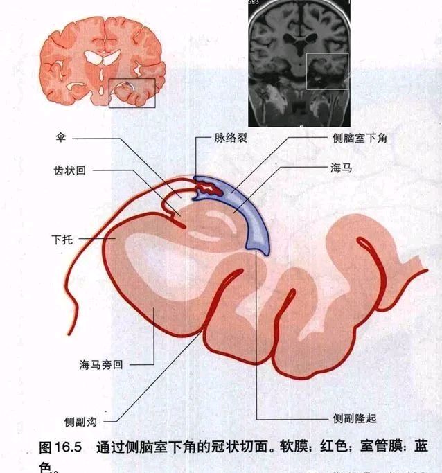 脉络膜裂囊肿