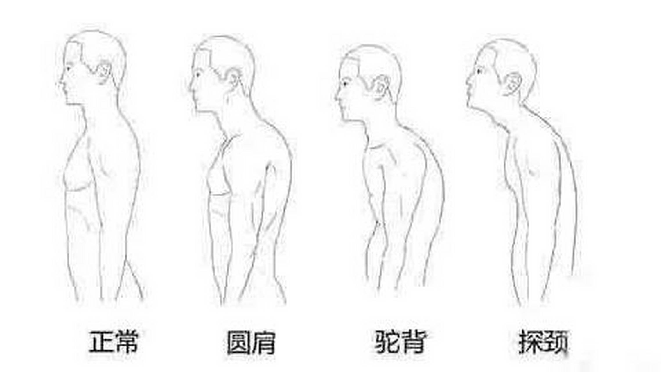 很多人存在圆肩驼背探颈的问题,其实这是种病,专业术语叫作上交叉