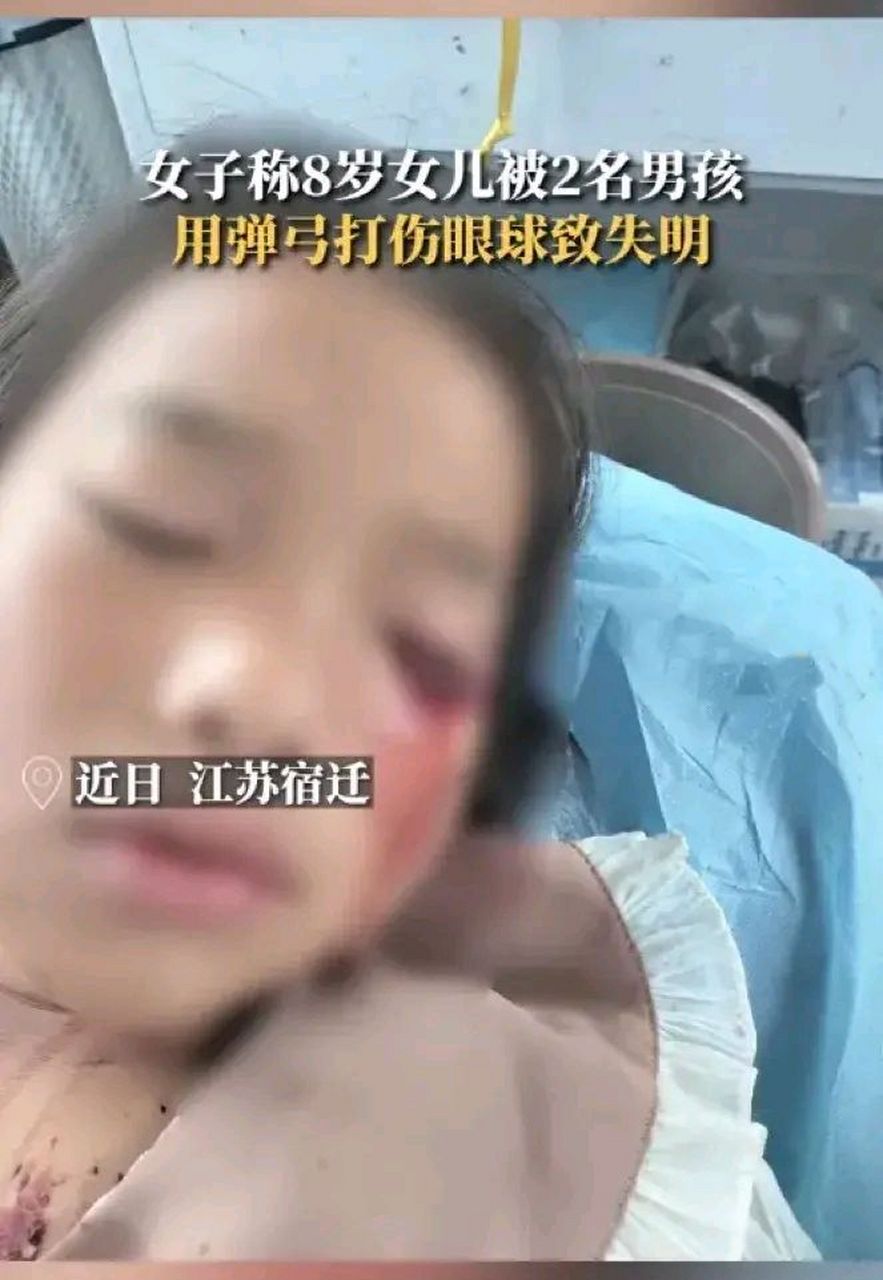江苏8岁女孩被弹弓打中眼睛,眼球破裂失明