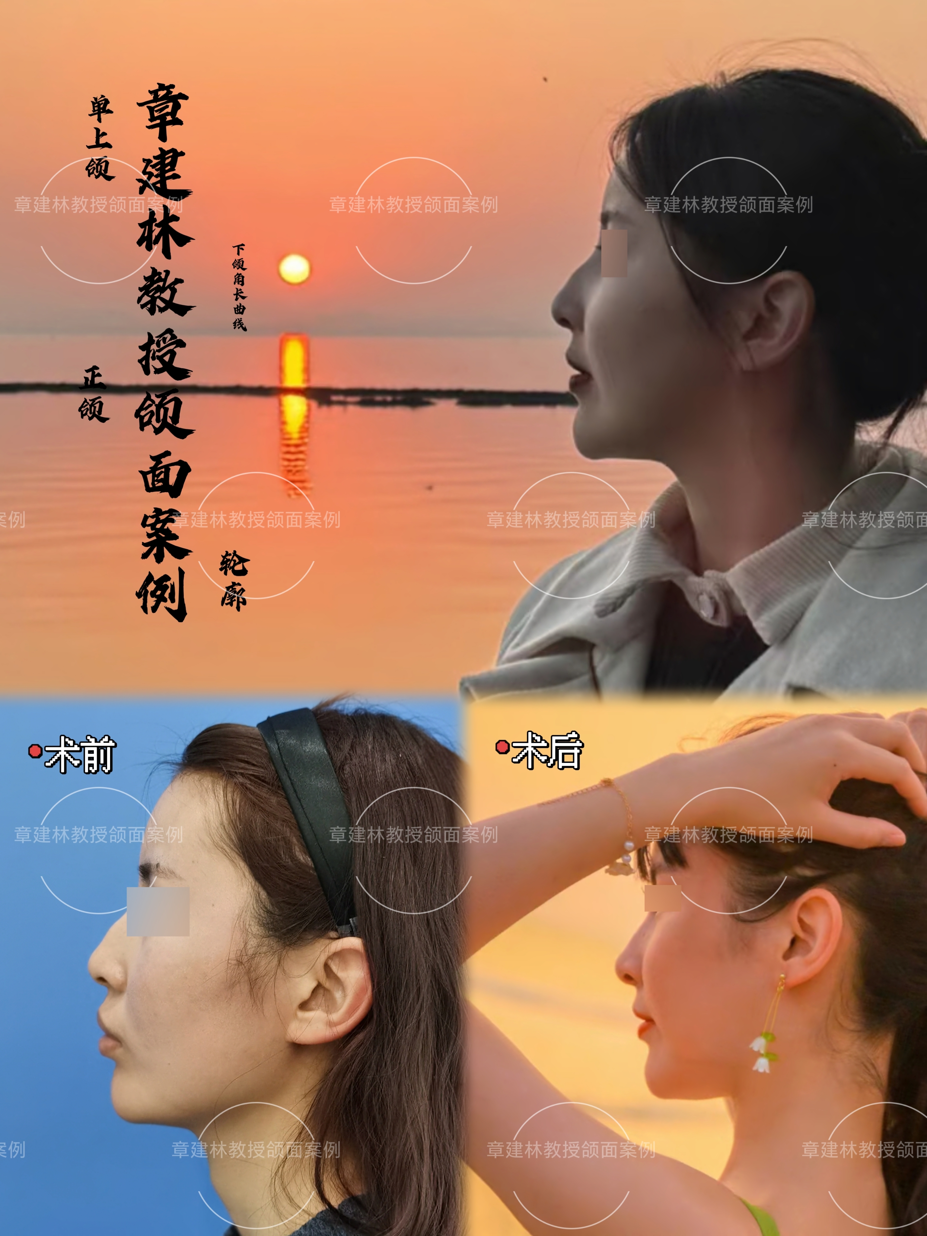 术前嘴突唇厚嘴唇形态不佳下颌角肥大正面显土气侧面不够柔和