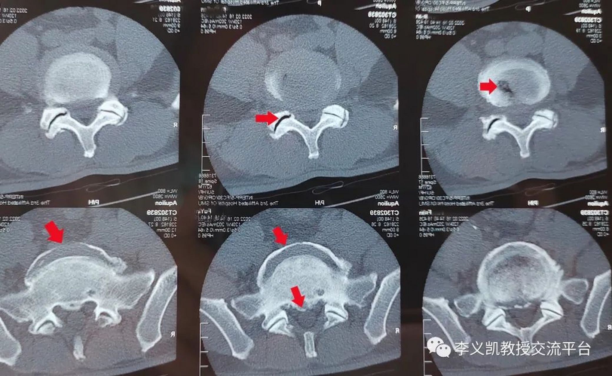 本例患者的腰椎ct平扫的图像上可见有3处真空征,即位于腰椎间盘内和