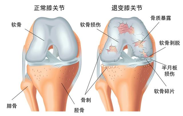 膑骨关节炎图片