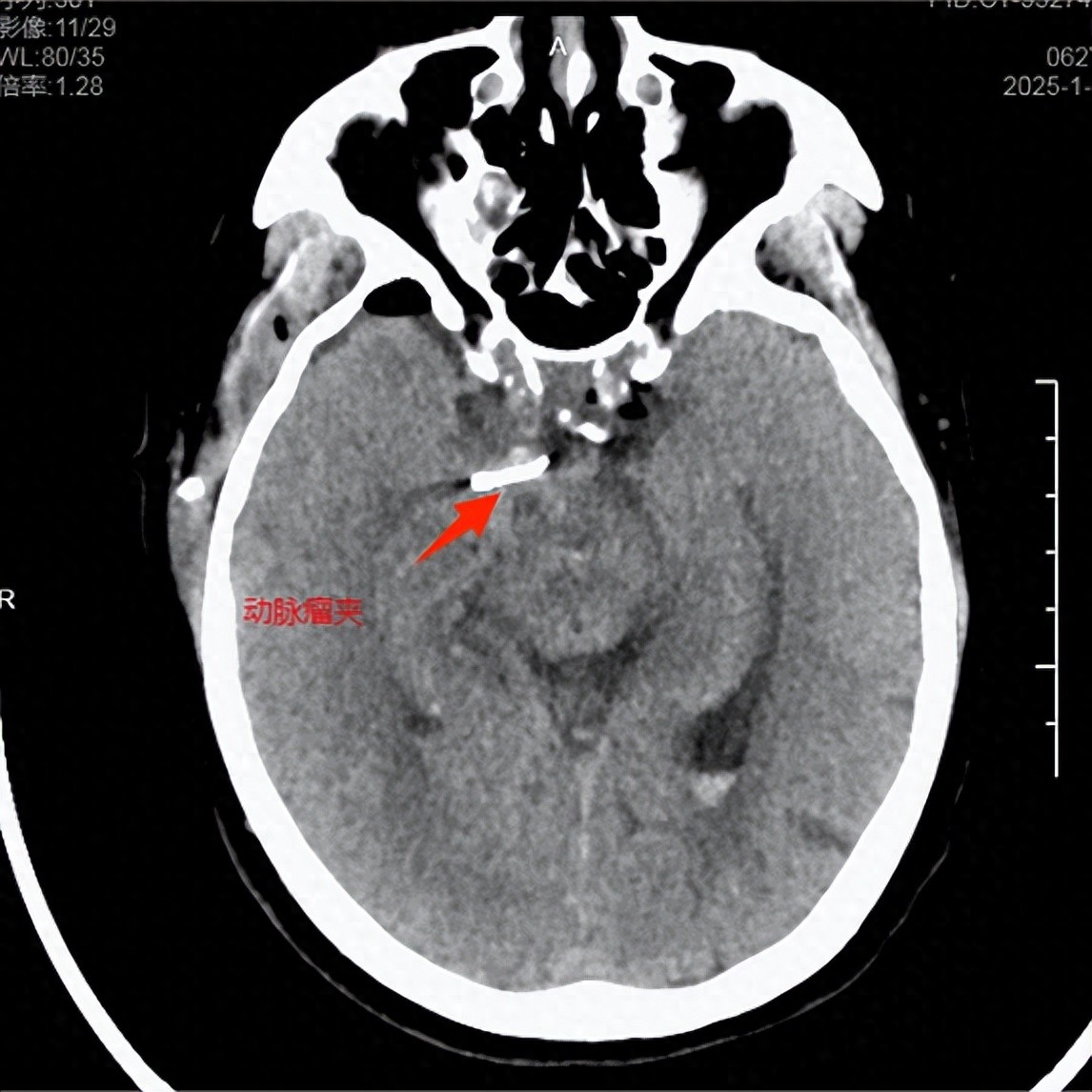女子颅内动脉瘤破裂出血命悬一线!医护团队紧急"拆弹"挽救生命