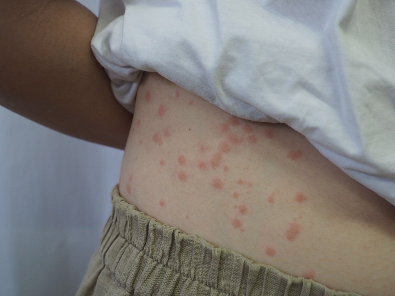 本以为是银屑,没想到是早期梅毒,医生都不敢碰!