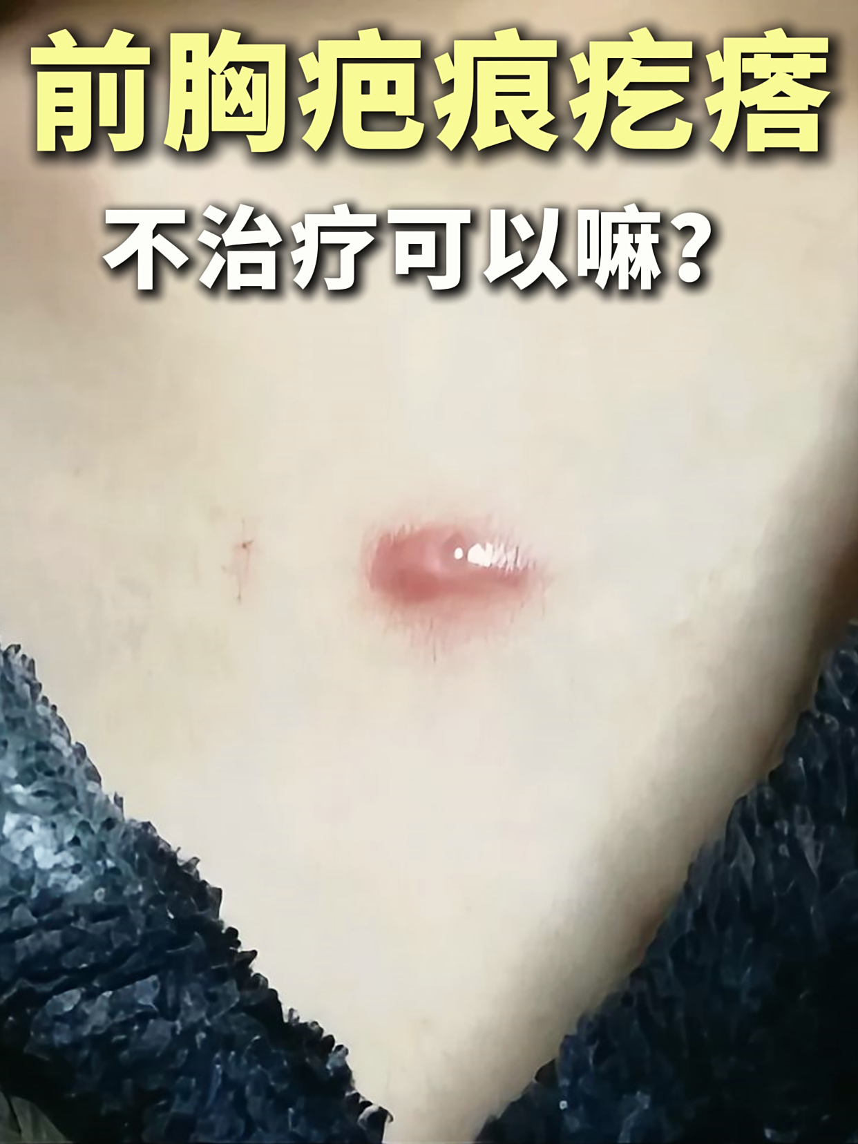 胸前疤痕疙瘩7年之久