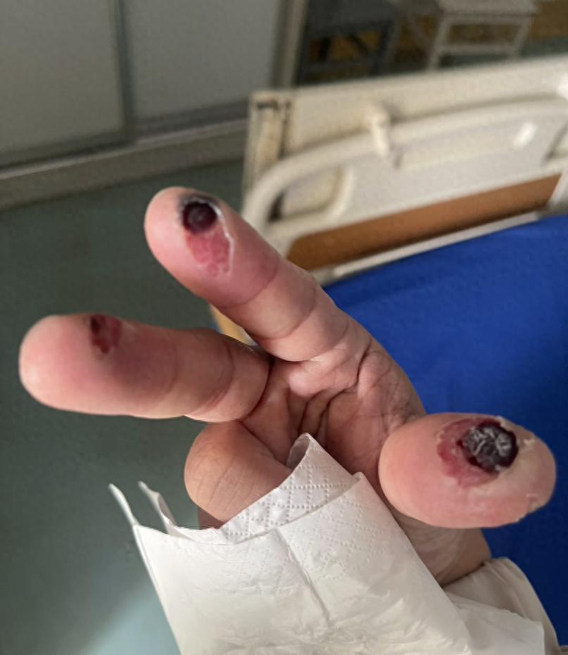 清理陶瓷花纸,戴了两层布手套不幸被腐蚀,福建钟先生险些痛失3根手指