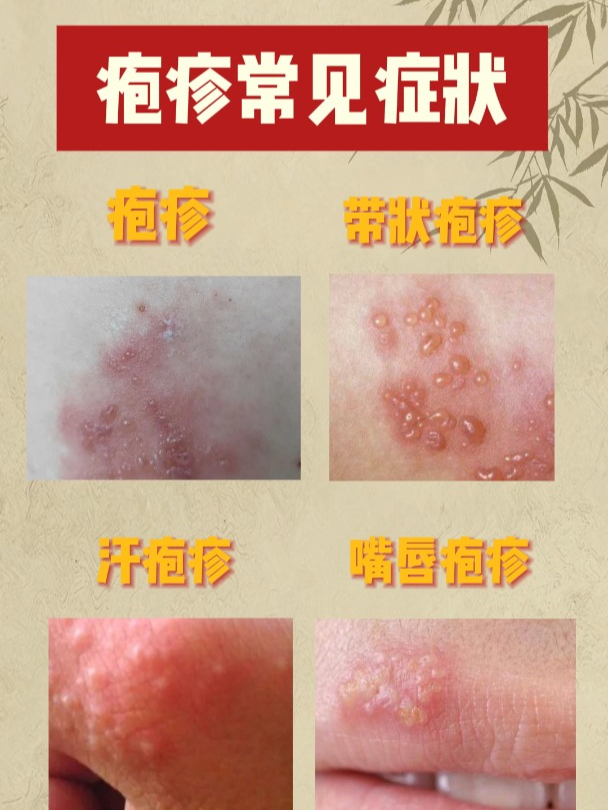 疱疹常见症状,原因与注意事项,你知道吗?